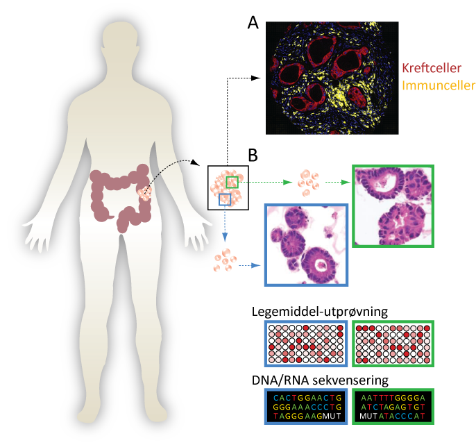 Figur. Pasient med tarmkreft. A) Mikroskopibilde av en svulst med mikrosatellitt-ustabilitet, som viser den høye graden av infiltrasjon av immunceller i slike svulster. B) Mikroskopibilder av «mini-svulster» dyrket i laboratoriet. Disse testes for sensitivitet for en rekke kreftlegemidler, og analyseres for genetiske endringer, med formål om å tilpasse behandlingen til den enkelte pasient.